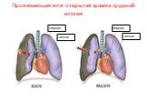 Проникающая или открытая травма грудной клетки. сердце легкое
