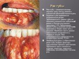 Рак губы. Рак губы - злокачественная опухоль зоны мезду кожей и слизистой оболочкой полости рта. Верхняя губа поражается относительно редко. Заболеваемость раком губы от общекого количества заболеваний раком в России составляет примерно 1.5%. Заболевание раком губы у мужчин встречается примерно в 10
