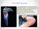 При прикосновении к щупальцам медузы, возникает сильное жжение, болевой шок, даже потеря сознания. Затем появляются симптомы отравления: сухость во рту, затруднение дыхания, иногда - смерть. ОПАСНЫЕ МЕДУЗЫ