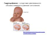 Гидроцефалия – следствие увеличенного объема ликвора в раннем онтогенезе. http://ggmanagement.pl/kutsat.php?q=what-is-hydrocephalus-in-infants