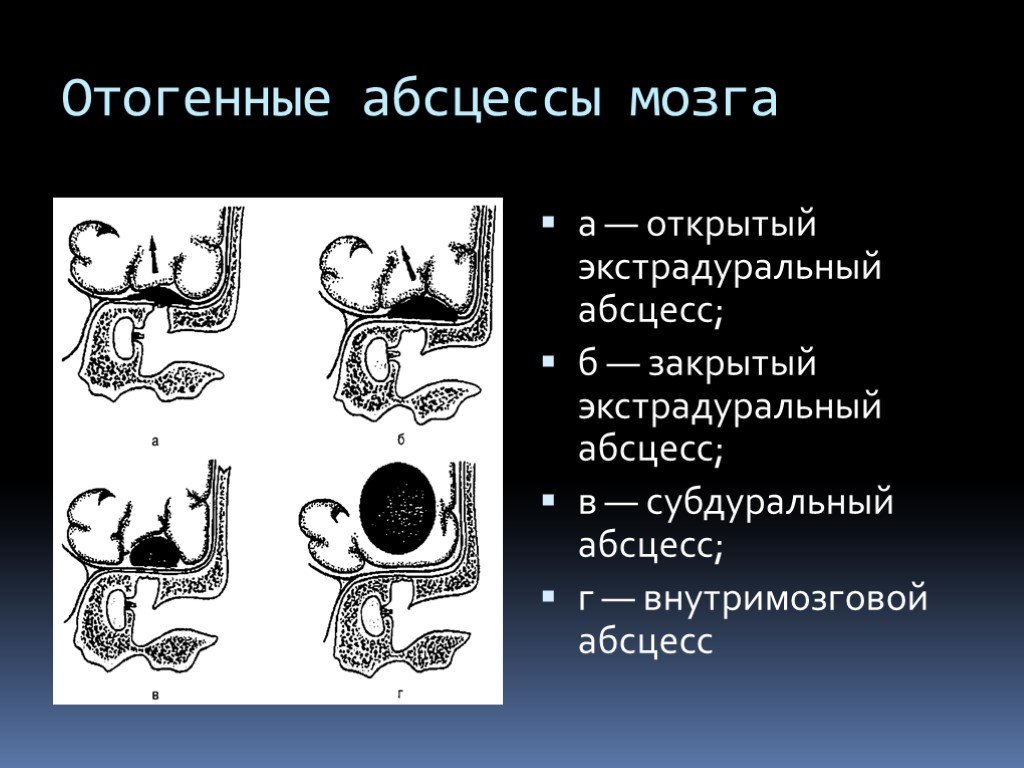 Экстрадуральный абсцесс. Отогенный экстрадуральный абсцесс. Отогенный абсцесс мозжечка.