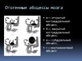 Отогенные абсцессы мозга. а — открытый экстрадуральный абсцесс; б — закрытый экстрадуральный абсцесс; в — субдуральный абсцесс; г — внутримозговой абсцесс