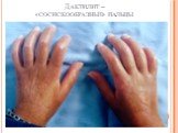 Дактилит – «сосискообразные» пальцы