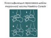 Классификация переломов шейки таранной кости Hawkins-Canale