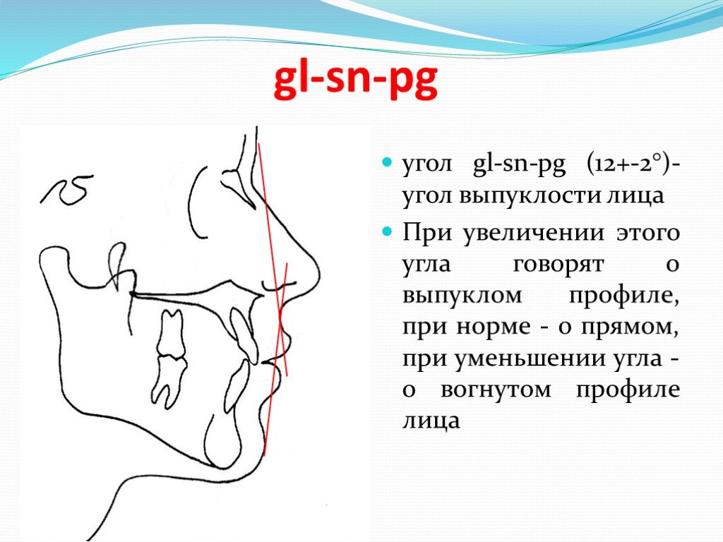 Скажи угол. Угол профиля лица. Угол выпуклости лица. При выгнутом профиле угол выпуклости лица. Угол профиля лица gl-SN-PG.