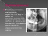 Рентгенологически: нарушение целостности кости в области скулоальвеолярного гребня в аскальной проекции; снижение прозрачности верхнечелюстных пазух.