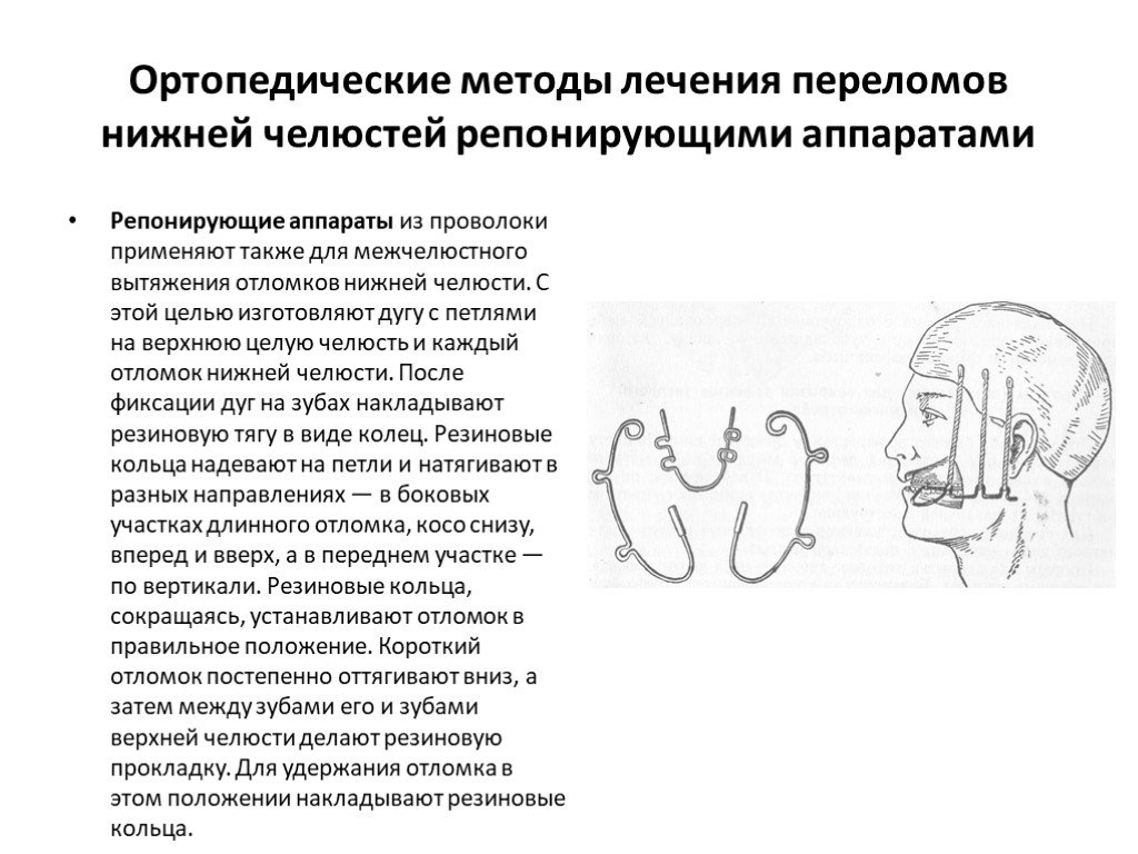 Лечение челюсти. Репонирующие ортопедические аппараты. Ортопедические методы переломов нижней челюсти. Фиксирующие аппараты при переломах челюстей. Оперативные методы лечения переломов верхней челюсти.