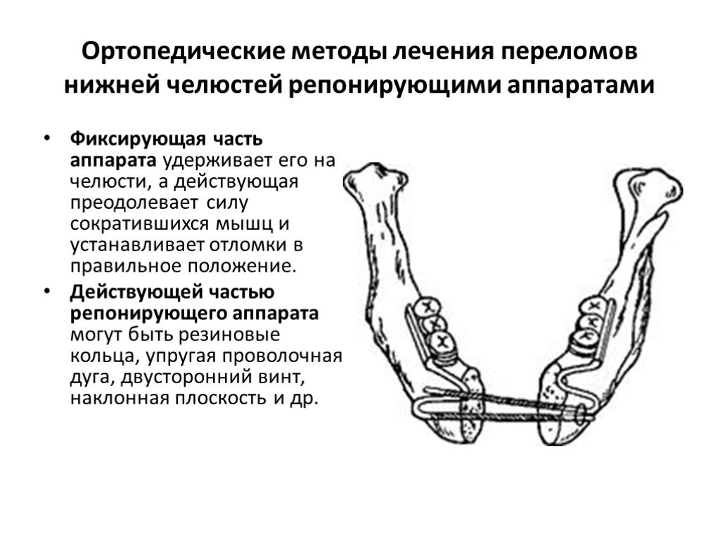 Переломы верхней и нижней челюсти презентация