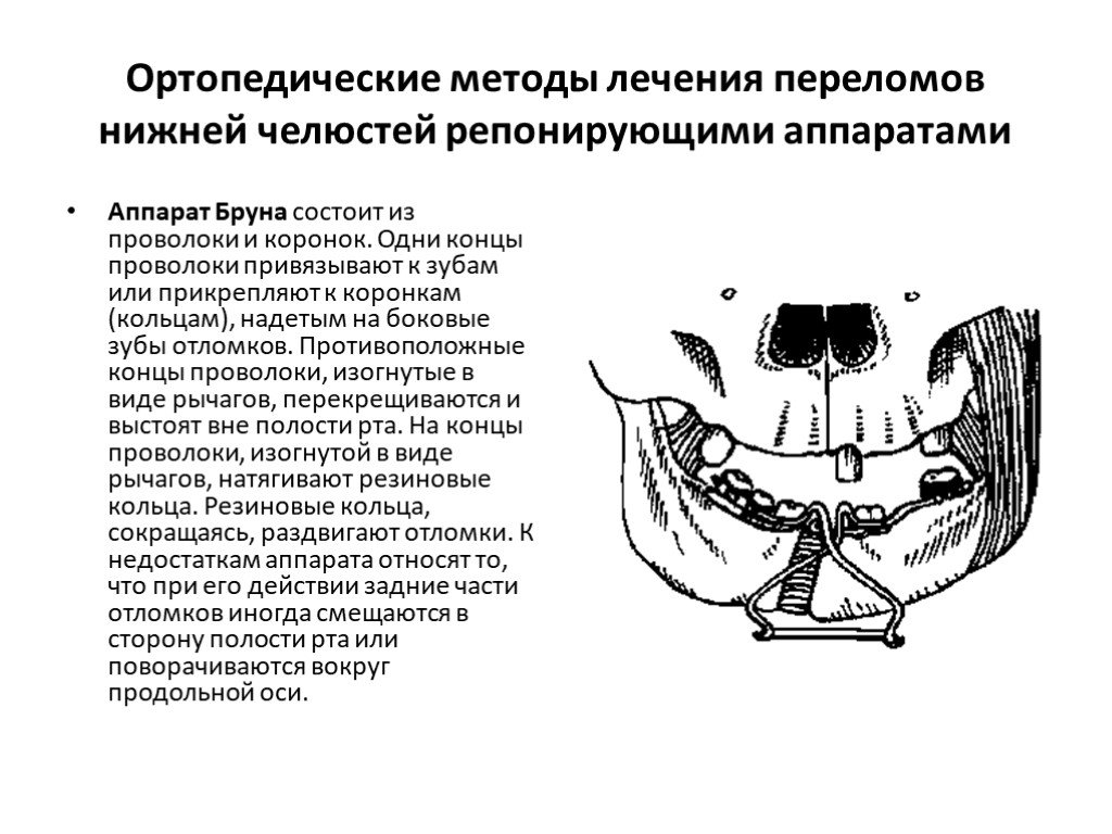 Лечение нижней челюсти. Репонирующий аппарат Бруна. Ортопедический аппарат челюстей репонирующие аппараты. Апаараты для лечениянидней челбсти переломы. Внеротовые аппараты для лечения переломов нижней челюсти.