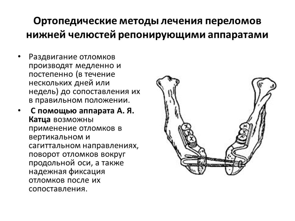 Перелом нижний. Аппараты для репозиции отломков челюстей. Ортопедические методы лечения переломов нижней челюсти. Репонирующие ортопедические аппараты. Репонирующий аппарат Катца.