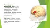 Межполушарная асимметрия мозга - это сложное свойство мозга, отражающее различие в распределении нервно-психических функций между его правым и левым полушариями. 1861 год - П. Брока открыл «центр» речевой моторики в левом полушарии головного мозга. Центр Брока