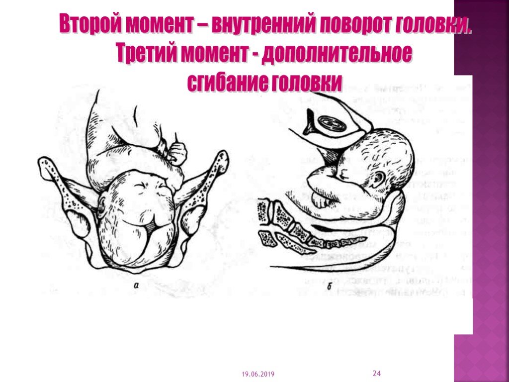 Биомеханизм родов при заднем виде затылочного предлежания презентация