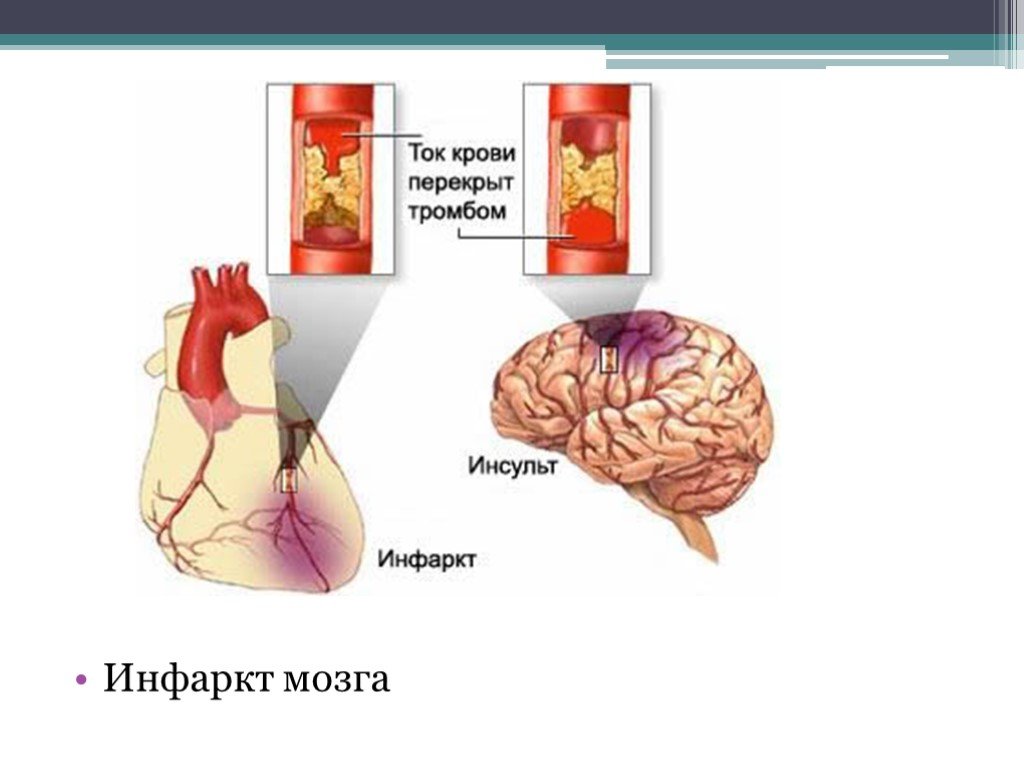 Презентация на тему инсульт и инфаркт