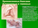 Хромосомные болезни Аутосомные и половые. Синдром Патау (трисомия по 13 хромосоме). Наблюдается с частотой 1 на 5000 родов. У новорождённых средняя масса тела. Умственная отсталость тяжёлая, многие дети страдают глухотой. Нередко обнаруживается умеренная микроцефалия с нависающим лбом, большие анато