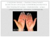 Синдром Рейно – пароксизмальный вазоспазм сосудов, сопровождающийся последовательным изменением кожи (побледнение, цианоз, гиперемия)