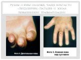 Рубцы и язвы на коже, чаще в области «подушечек» пальцев и зонах повышенной травматизации.