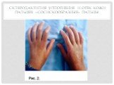 Склеродактилия уплотнение и отек кожи пальцев: «сосискообразные» пальцы