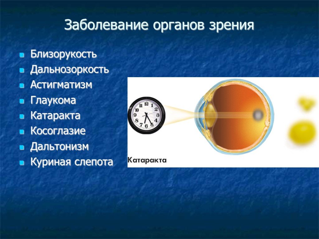 Заболевания глаз биология 8 класс. Заболевания органов зрения. Патологии органов зрения. Нарушение органов зрения. Нарушение зрения заболевания.