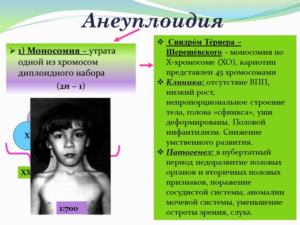 Синдром тернера какая хромосома. Моносомия Шерешевского Тернера. Анеуплоидия болезни человека. Трисомия Шерешевского-Тернера трисомия. Синдром Шерешевского Тернера анэуплоидия.