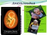 2) Трисомия – наличие трёх гомологичных хромосом вместо пары (2n + 1). Синдро́м Да́уна - трисомия по 21 хромосоме, кариотип – 47 хромосом. Клиника: малый рост, круглая голова со скошенным затылком, нос с широкой плоской переносицей, рот полуоткрыт, укорочение конечностей, нервно-психическое развитие