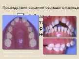 Подобные зубочелюстные деформации нарушают смыкание губ. Последствия сосания большого пальца