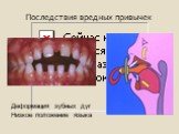 Деформация зубных дуг Низкое положение языка. Последствия вредных привычек
