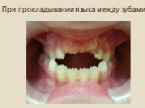 При прокладывании языка между зубами