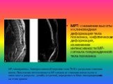 МРТ: снижение высоты и клиновидная деформация тела позвонка, кифотическая деформация, изменение интенсивности МР-сигнала поврежденного тела позвонка. МР-томограммы. Компрессионный перелом тела Th10 с разрывом спинного мозга. Повышение интенсивности МР-сигнала от спинного мозга выше и ниже места разр