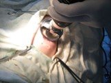 Реконструктивно-восстановительная хирургияТрансплантология Слайд: 87