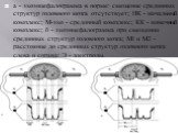 а - эхоэнцефалограмма в норме: смещение срединных структур головного мозга отсутствует; НК - начальный комплекс; М-эхо - срединный комплекс; КК - конечный комплекс; б - эхоэнцефалограмма при смещении срединных структур головного мозга; Ml и М2 - расстояние до срединных структур головного мозга слева