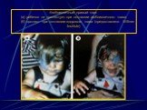 Амблиопичный правый глаз: (а) ребенок не протестует при окклюзии амблиопичного глаза; (б) протест при окклюзии здорового глаза (предоставлено Wilmer Institute)