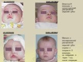 до операции после операции. Девочка 5 месяцев с односторонней расщелиной верхней губы: Малыш с изолированной расщелиной верхней губы справа в возрасте 2 месяцев: до операции и через 1 год после операции.