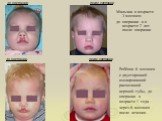 Мальчик в возрасте 3 месяцев: до операции и в возрасте 2 лет после операции. Ребёнок 6 месяцев с двусторонней изолированной расщелиной верхней губы, до операции в возрасте 1 года - через 6 месяцев после лечения.
