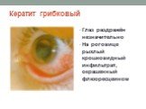 Кератит грибковый. Глаз раздражён незначительно На роговице рыхлый крошковидный инфильтрат, окрашенный флюоресцеином