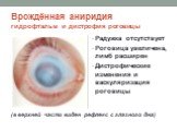 Врождённая аниридия гидрофтальм и дистрофия роговицы. Радужка отсутствует Роговица увеличена, лимб расширен Дистрофические изменения и васкуляризация роговицы. (в верхней части виден рефлекс с глазного дна)