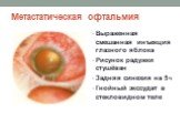 Метастатическая офтальмия. Выраженная смешанная инъекция глазного яблока Рисунок радужки стушёван Задняя синехия на 5 ч Гнойный экссудат в стекловидном теле