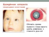 Врождённая катаракта сходящееся косоглазие. Область зрачка правого глаза серого цвета, рефлекса с глазного дна нет