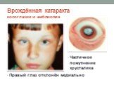 Врождённая катаракта косоглазие и амблиопия. Правый глаз отклонён медиально. Частичное помутнение хрусталика