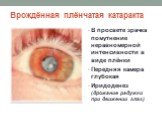 Врождённая плёнчатая катаракта. В просвете зрачка помутнение неравномерной интенсивности в виде плёнки Передняя камера глубокая Иридоденез (дрожание радужки при движении глаз)