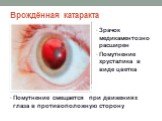 Врождённая катаракта. Зрачок медикаментозно расширен Помутнение хрусталика в виде цветка. Помутнение смещается при движениях глаза в противоположную сторону