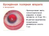Врождённая полярная катаракта и аниридия. Прикорневая часть гипопластичной радужки в виде сегмента от 6 до 10 ч В центре хрусталика помутнение диаметром около 1 мм