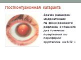 Постконтузионная катаракта. Зрачок расширен мидриатиками На фоне розового рефлекса с глазного дна точечные помутнения по периферии хрусталика на 8-12 ч