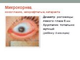 Микрокорнеа, косоглазие, микрофтальм, катаракта. Диаметр роговицы левого глаза 6 мм Хрусталик тотально мутный (ребёнку 6 месяцев)