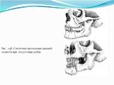 Рис. 238. Скелетное вытяжение нижней челюсти при отсутствии зубов.