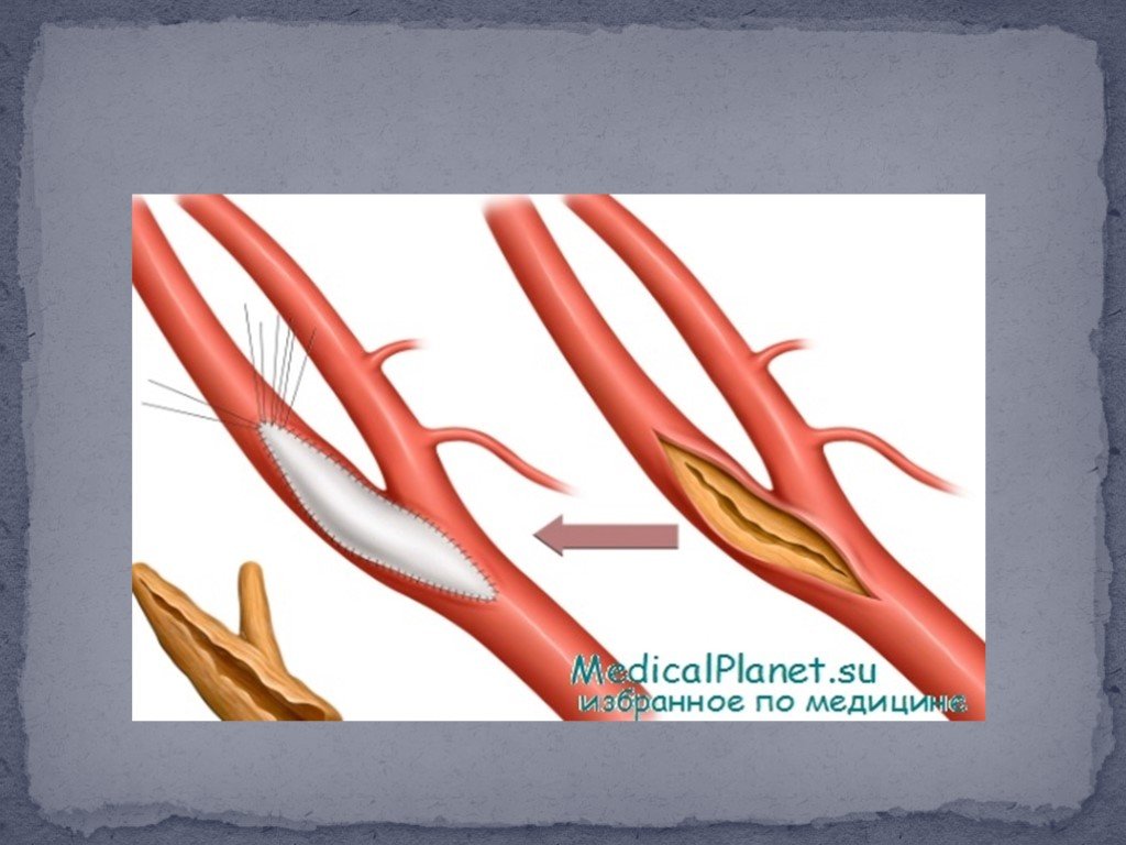 Тромбозы и эмболии артерий. Эмболия и тромбоз других уточненных вен.