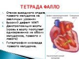 Стеноз выводного отдела правого желудочка на различных уровнях Высокий дефект МЖП Декстропозиция аорты (кровь в аорту поступает одновременно из обоих желудочков, правого и левого) Гипертрофия миокарда правого желудочка. ТЕТРАДА ФАЛЛО
