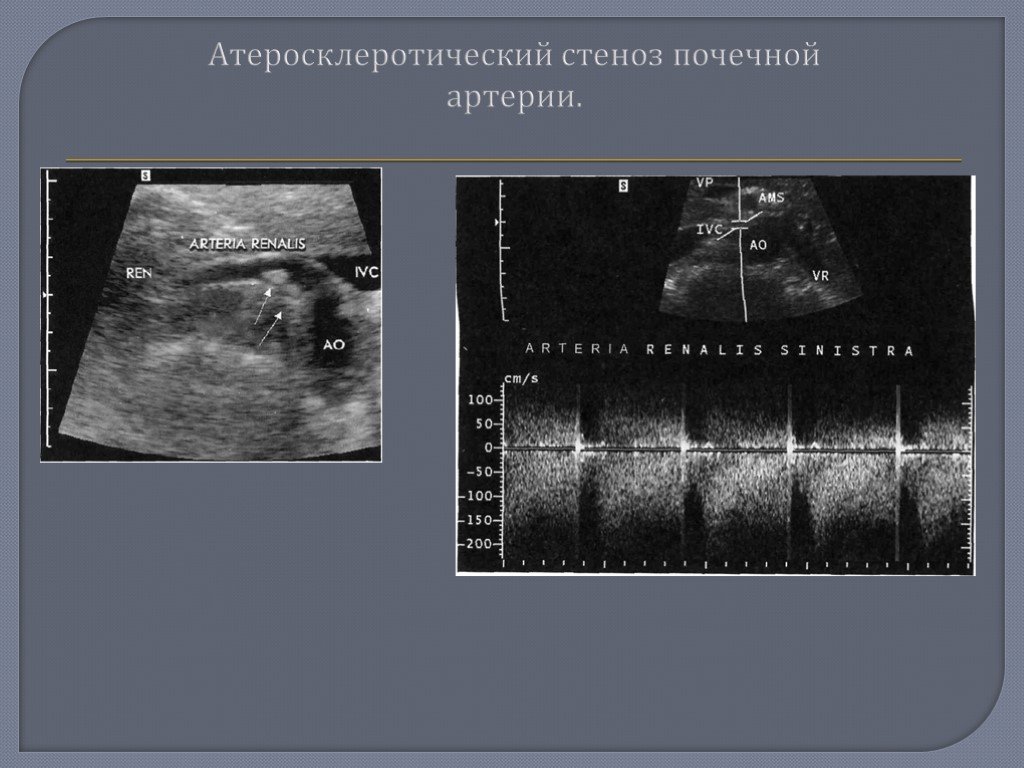 Узи почечных артерий. Стеноз почечных артерий УЗИ диагностика. Атеросклеротический стеноз почечной артерии. Стент почечнрй артерии. Степени стеноза почечной артерии.