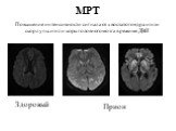 МРТ. Повышение интенсивности сигнала от хвостатого ядра и/или скорлупы и/или коры головного мозга в режиме ДВИ. Здоровый Прион