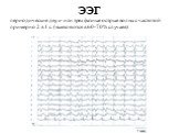 ЭЭГ. периодические двух- или трехфазные острые волны с частотой примерно 2 в 1 с. (выявляются в 60-70% случаев)