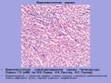 Веретеноклеточная дифференцированная саркома. Гистоструктура. Окраска Г-Э (х480) (по В.В. Серову, Н.Е. Ярыгину, В.С. Паукову) Веретенчатой и овальной формы клетки опухоли и волокна соединительной ткани образуют пучки, идущие в разных направлениях